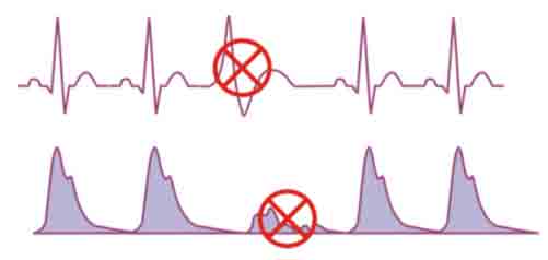 Example of an abnormal heartbeats